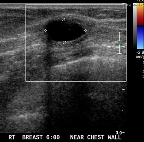 Figure 3 From Epidermoid Cyst Of The Breast Mammography Ultrasound