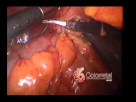 Colon, recto y ano | fisiología del sistema gastrointestinal | khan academy en español. Diverticulite do cólon sigmóide - YouTube