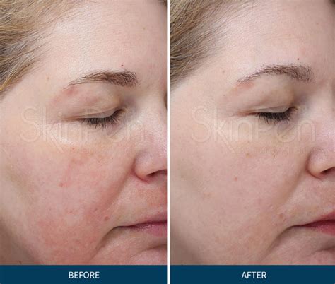 Microneedling Before And After Raederma