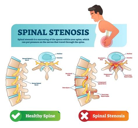 Spinal Stenosis Types Causes Symptoms Diagnosis Treatment Risks My