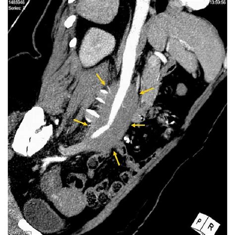 Preoperative Contrast Enhanced Axial Ct Images Demonstrate That The