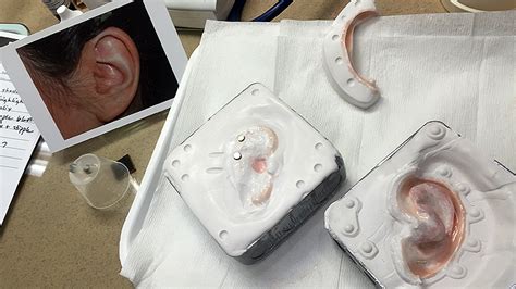 Prosthetic Ear Ear Prosthesis Microtia Wisconsin — Life Like