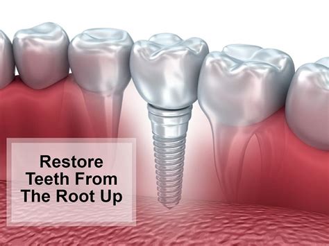 Rochester Dental Implants Cosmetic Dentistry Greece Ny