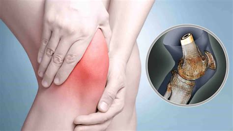 Inflamação No Joelho Sintomas
