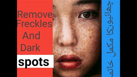 Get Rid Remove Freckles Naturally In A Week By Beauty With Herbal Youtube