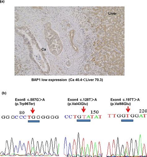Bap1 Expression And Detected Mutations In Clinical Gbc Id 12 A Download Scientific Diagram