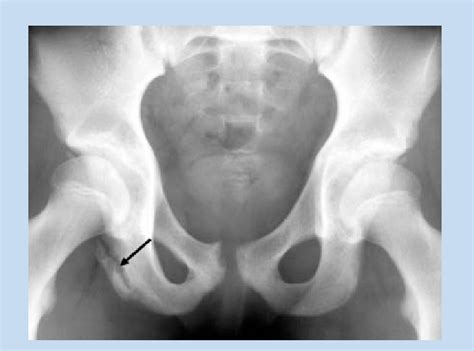 Anteroposterior Radiograph Of The Pelvis Demonstrates An Ischial