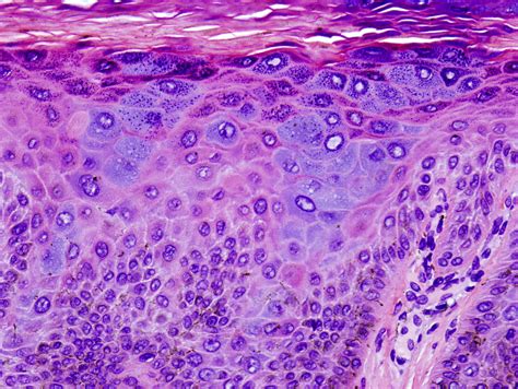 Epidermodysplasia Verruciformis Histology