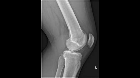 Radiographic Positioning Of The Knee