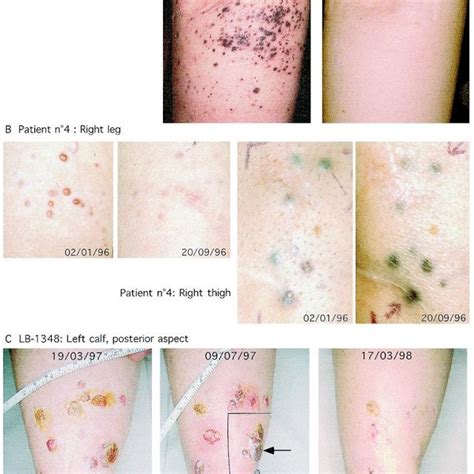 Evolution Of Cutaneous And Subcutaneous In Transit Melanoma Metastases