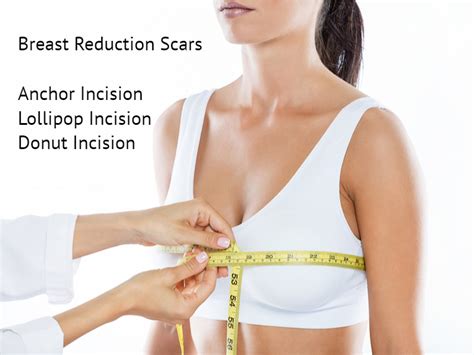 Breast Reduction Scar Faqs Plastic Surgery And Cosmetic Surgery Procedures Costs Risks
