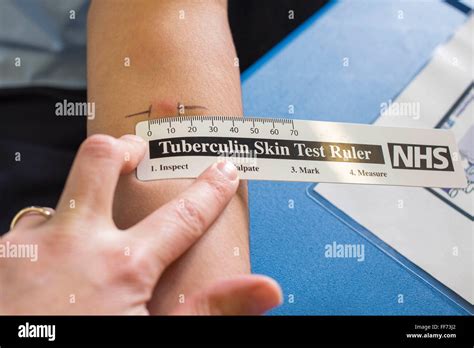 Tb Skin Test Ruler Printable