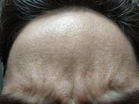 Rough Bumpy And Sandy Texture Especially On Forehead And Thousands Of