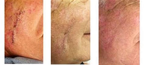 Mohs Surgery Manhattan Skin Cancer Treatments Nyc