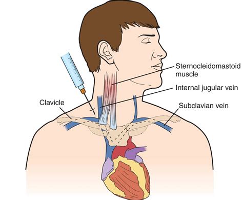 Subclavian Vein—central Venous Access Anesthesia Key