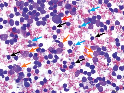 Top 5 Cytologic Findings In Aspirates Of Enlarged Lymph Nodes