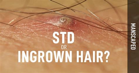 Std Or Ingrown Hair Ingrown Hair Health Blog