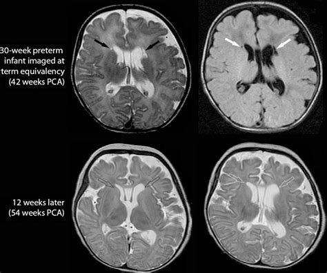 Evolution Of A Focal Cystic Pvl In An Infant Born At 30 Weeks Pca