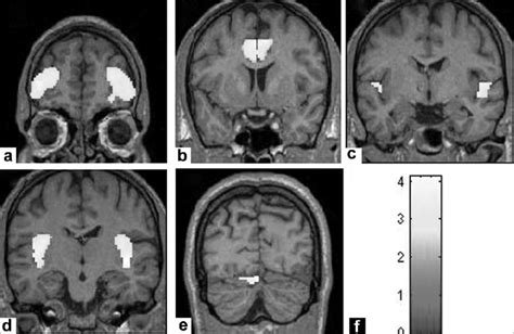 Figure Shows Gray Matter Volume Deficits In Schizophrenia Patients N 5