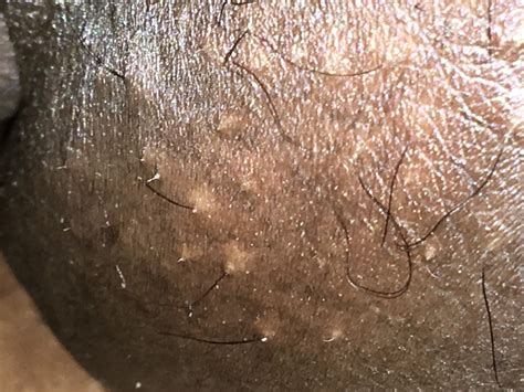 Herpes can confuse anyone to think it's simply a pimple or an ingrown hair. Is this herpes or folliculitis | Genital Herpes Simplex ...