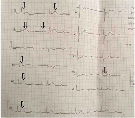 Cardiology Window Inferior Wall Myocardial Infarction With Complete