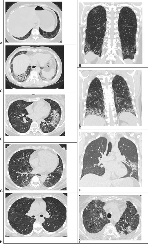 Sjögren Syndrome Associated Interstitial Lung Disease Ss Ild