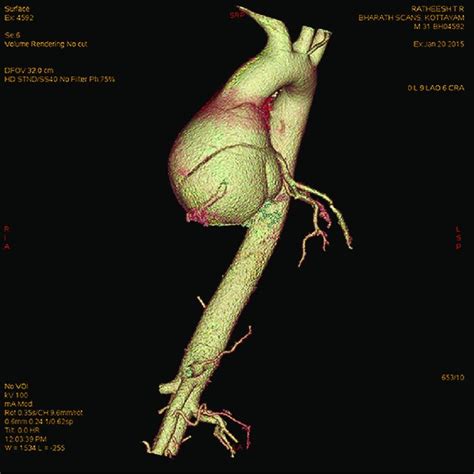 Computed Tomography Aortogram Sagittal View Showing Aortic Root