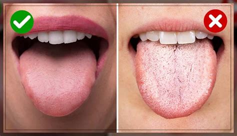 White Tongue Causes Risks And Treatment Dentist Ahmed