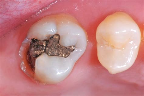 How To Care For A Broken Tooth Stensland Dental Studio