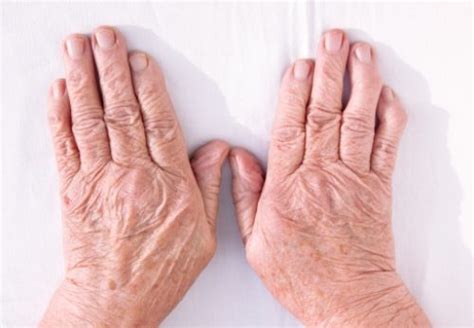Rheumatoid Arthritis And Skin Problems Causes And Treatment