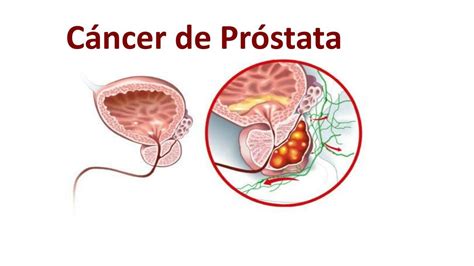 Cáncer de prostata Escuela medica uDocz