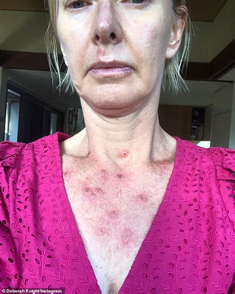 Deborah Knight 50 Reveals Painful Looking Welts On Her Chest