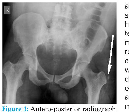 Figure 1 From The Acute And Chronic Presentation Of Gluteus Medius