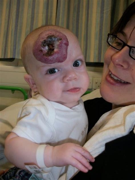 New Parents Shock As Babys Tiny Bruise On Forehead Grows Into
