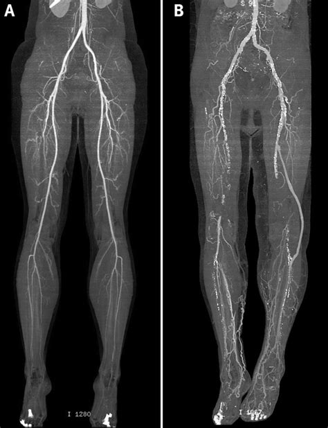 Computed Tomography Angiograms Showing A Normal Lower Limb