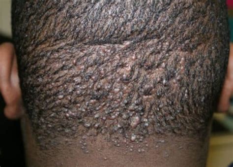 Bumps On The Scalp At The Back Of Head Due To Acne Keloidalis Nuchae