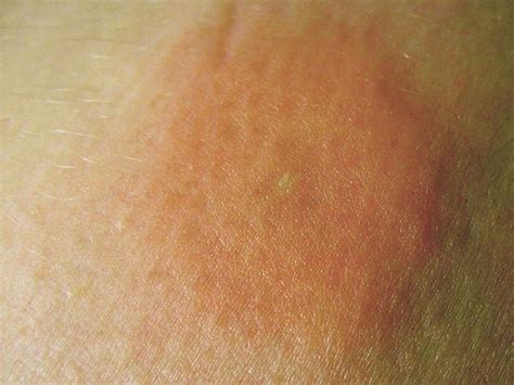 13 Common Bug Bites And How To Spot Them Identifying Bug Bites Brown