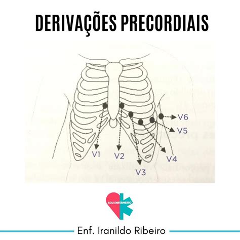 Derivações Precordiais V1 V2 V3 V4 V5 E V6