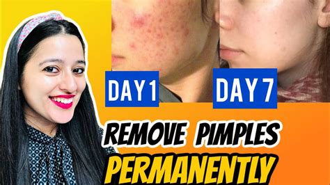 How To Remove Pimples Naturally And Permanently Youtube