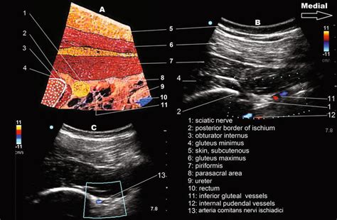 See more of ultrasound guided nerve block: A simple and successful sonographic technique to identify ...