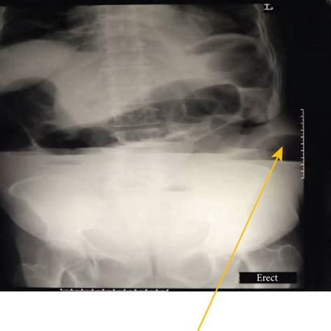 Abdominal X Ray Anteroposterior Showing Air Fluid Level With A