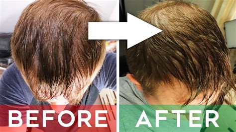 Finasteride Review Does It Cure Hair Loss Finasteride Before And