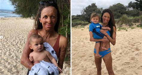 Nspirational Burns Survivor Turia Pitt And One Year Old Son Hakavai Match In Blue At The Beach