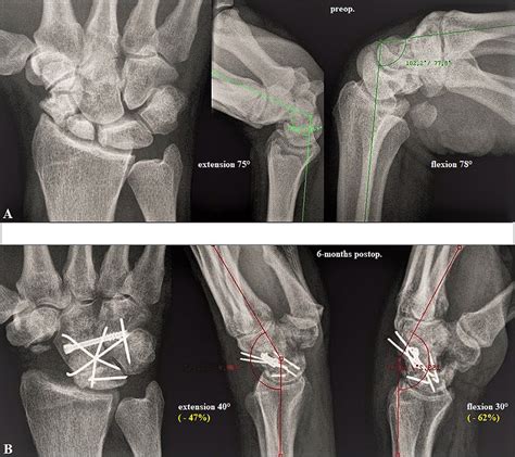 Functional Outcomes After Salvage Procedures For Wrist Trauma And Arthritis Four Corner Fusion