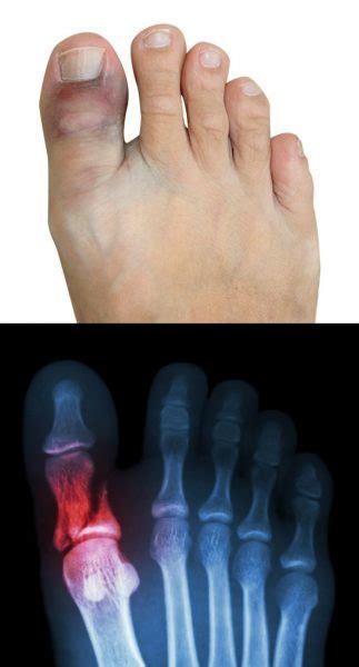 Although broken toes are well known, the treatment of them seems to be clouded with many unknowns and falsehoods. Sprained Big Toe vs. Broken Big Toe: Causes, Symptoms ...