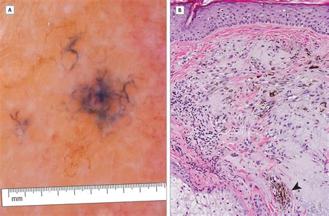 Dermoscopic Appearance Of Intraluminal Hematogenous And Lymphatic