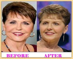 Celebrities Plastic Surgery Before And After