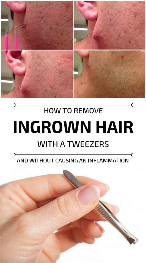 How To Remove Ingrown Hair Neck Howtoermov