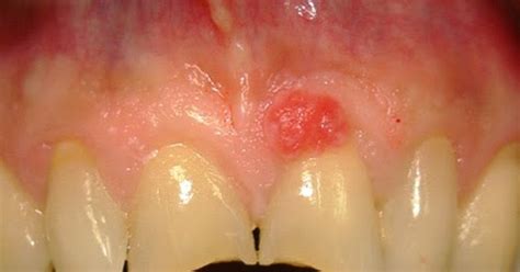 Odontología Lesiones Hiperplásicas De La Cavidad Bucal
