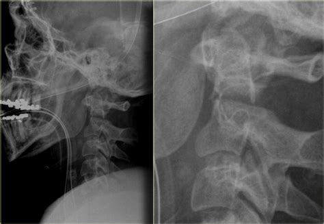 The Radiology Assistant Cervical Injury